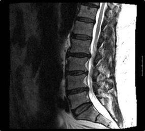 x-ray ng cervical spine na may osteochondrosis