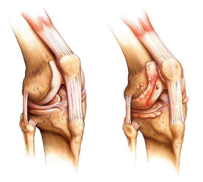 Malusog na joint (kaliwa) at arthritic joint (kanan)