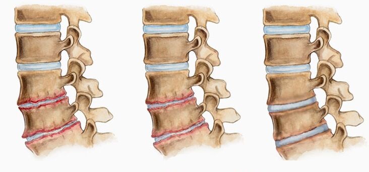 Ang pagpapapangit ng mga intervertebral disc sa osteochondrosis ay maaaring maging sanhi ng pananakit ng likod