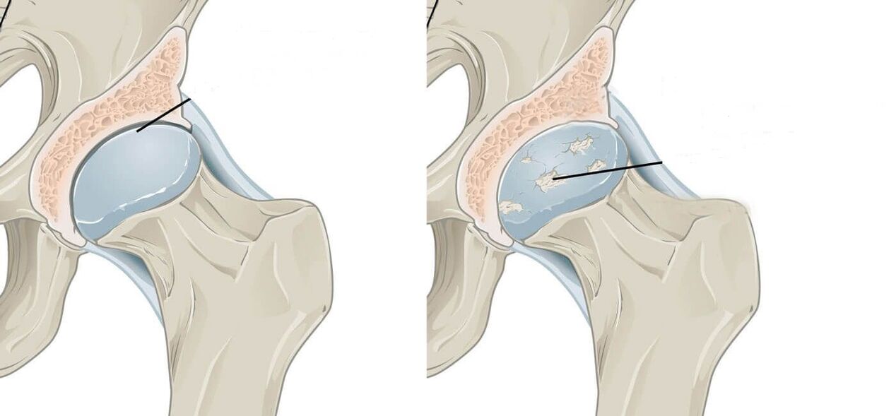 malusog at apektadong hip joint na may arthrosis