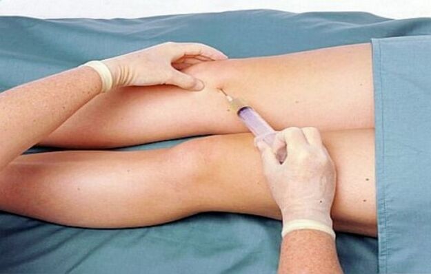 Ang antas ng arthrosis ng kasukasuan ng tuhod