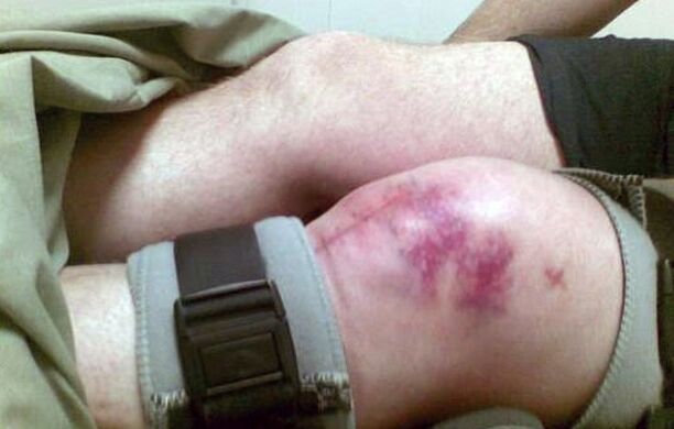 Ang mga sanhi ng arthrosis ng kasukasuan ng tuhod