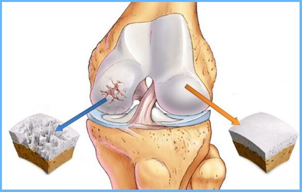 Arthrosis ng kasukasuan ng tuhod