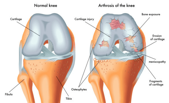 Normal na pinagsamang at apektado ng arthrosis